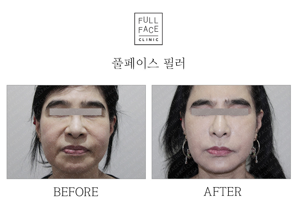 Fullface filler before and after case
