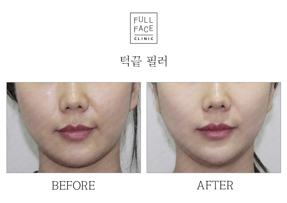 Filler