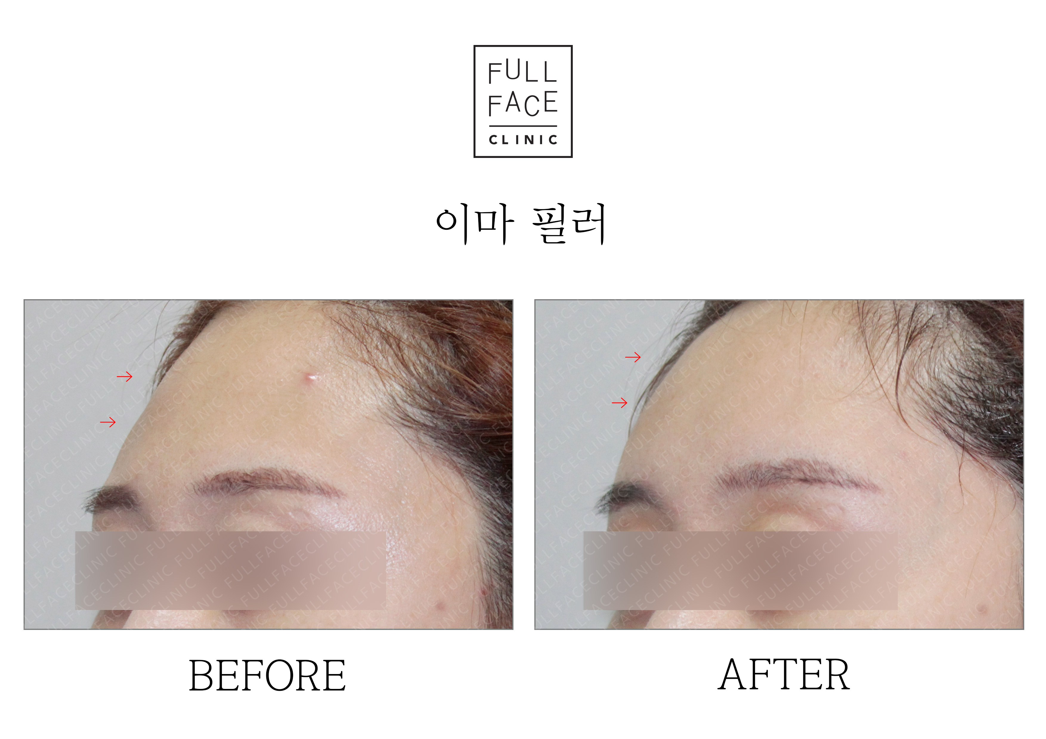 Filler