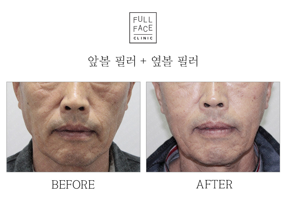 Before & After Case