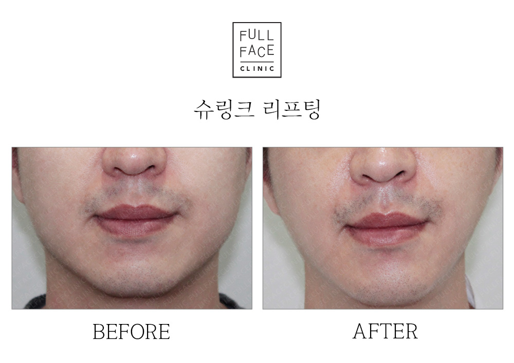 리프팅 레이저