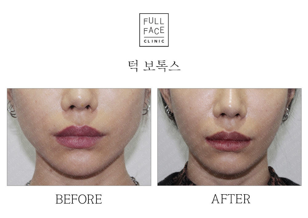 Before & After Case