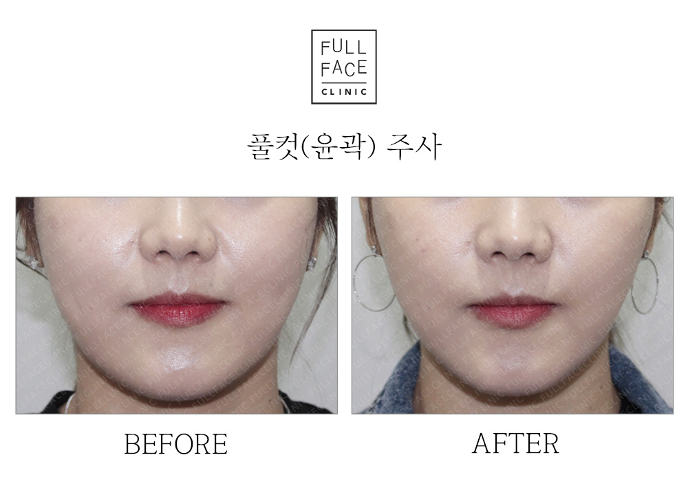 Before & After Case