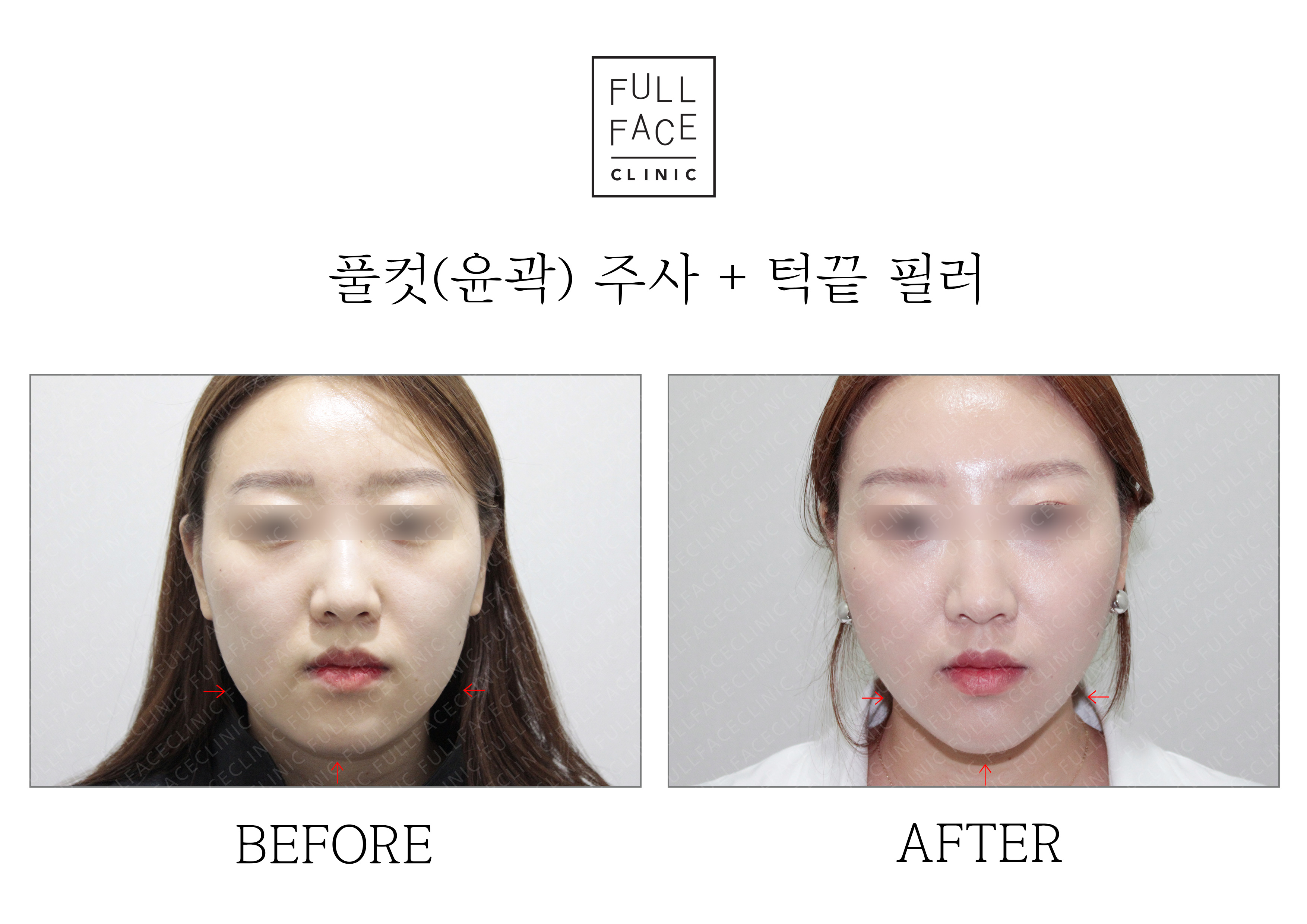 Before & After Case