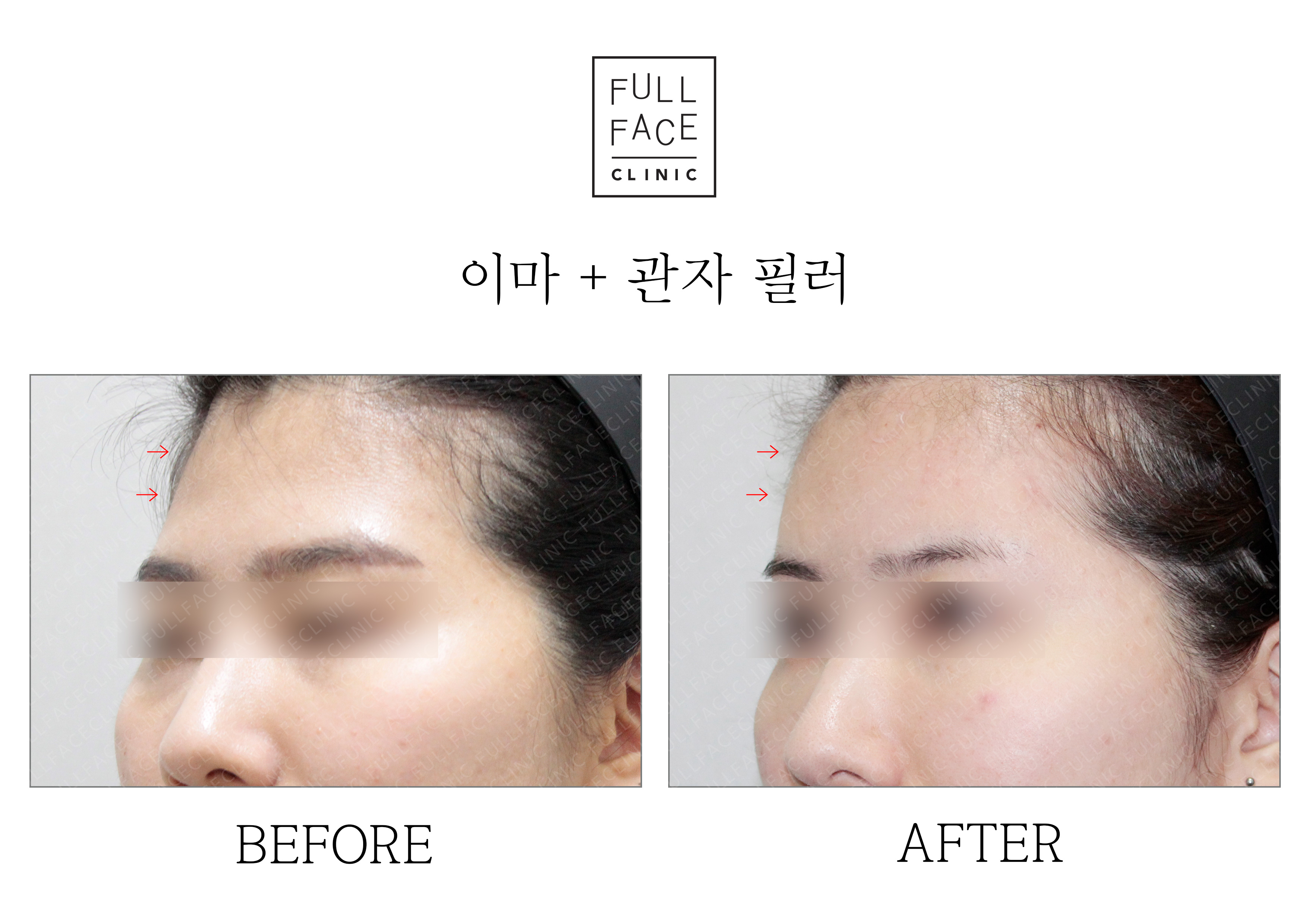 Before & After Case