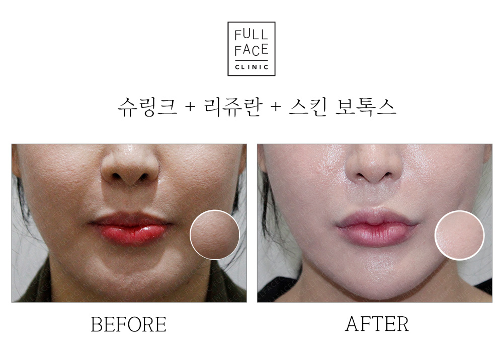 Before & After Case