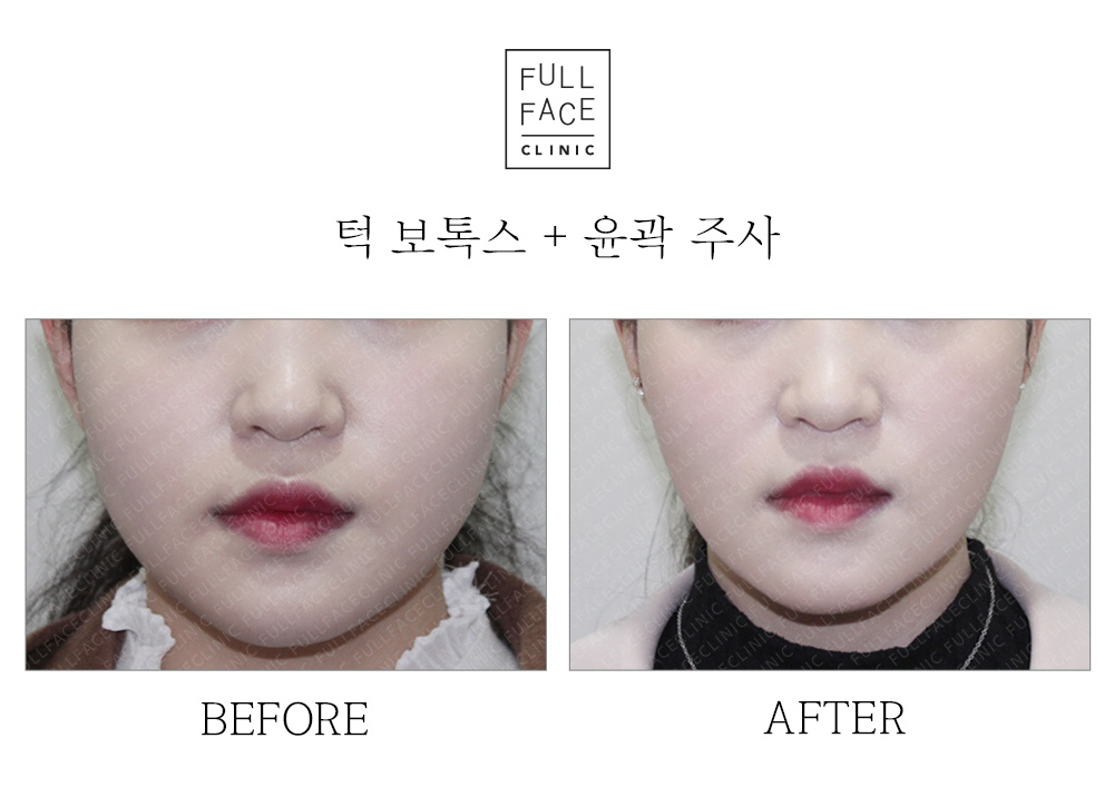 Before & After Case