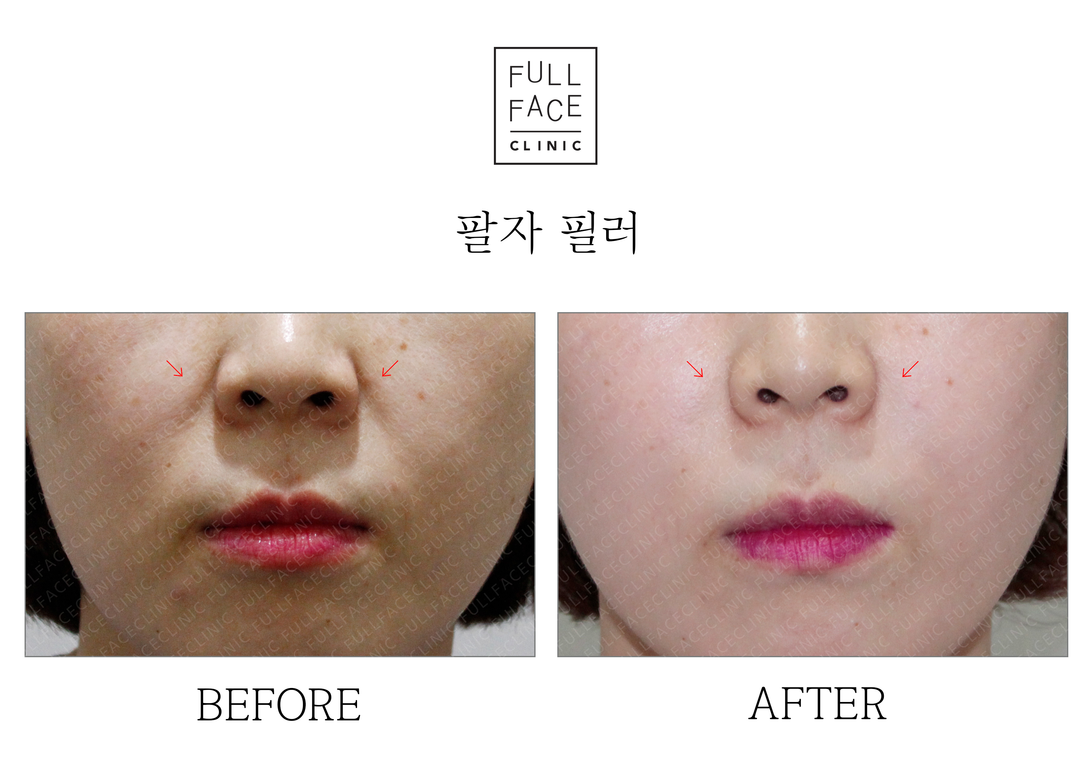 Before & After Case