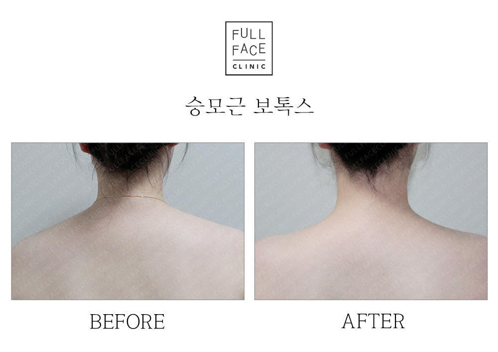 Before & After Case