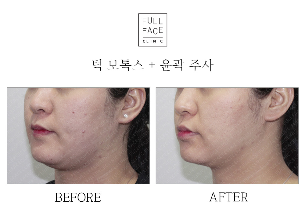 Before & After Case