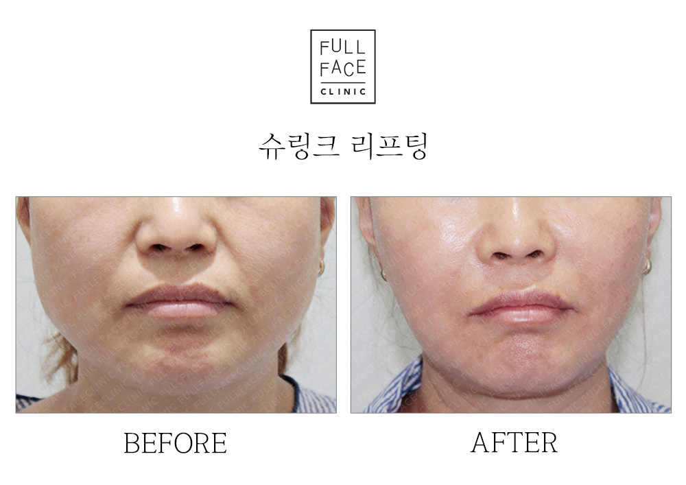 Before & After Case