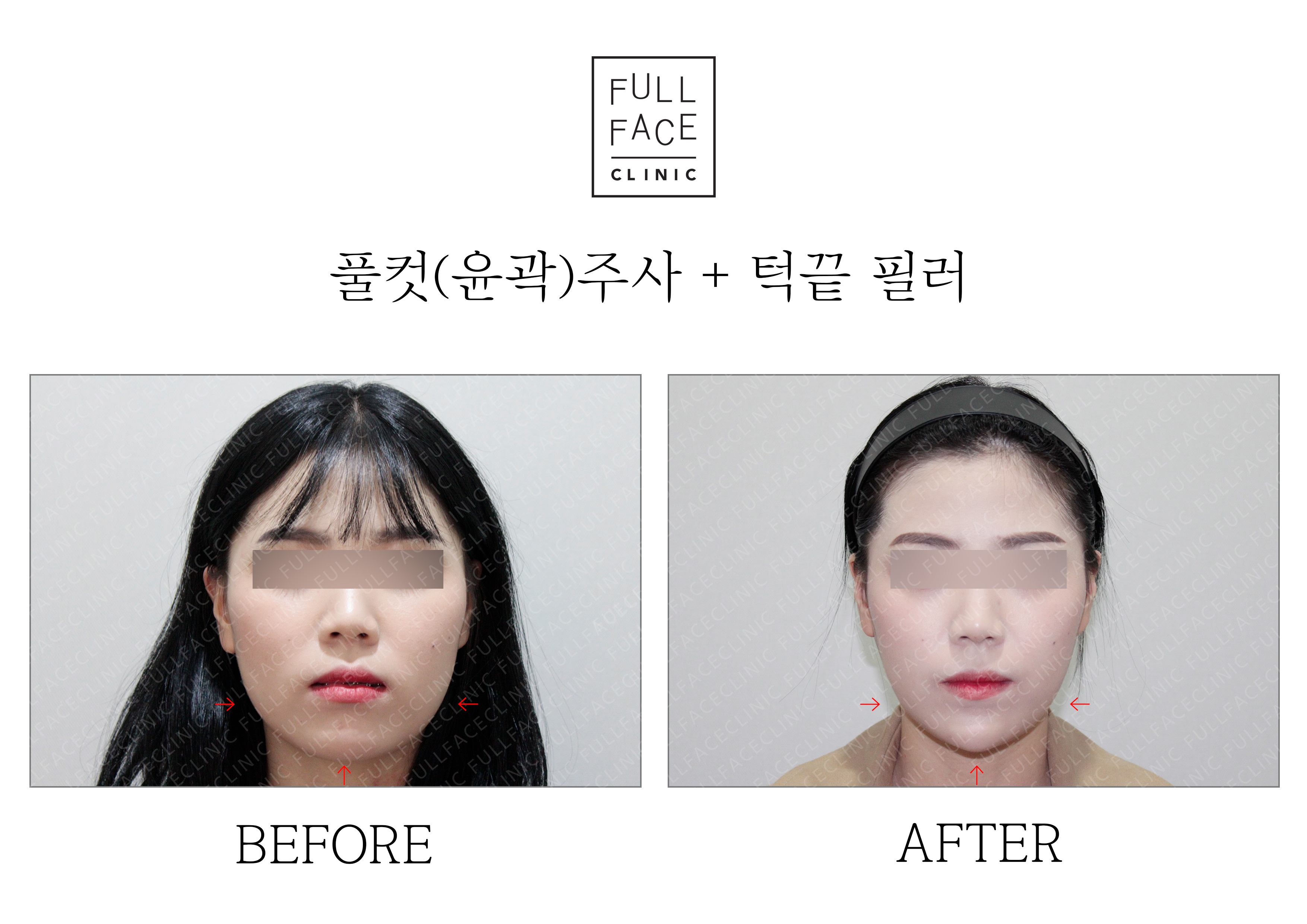 Before & After Case