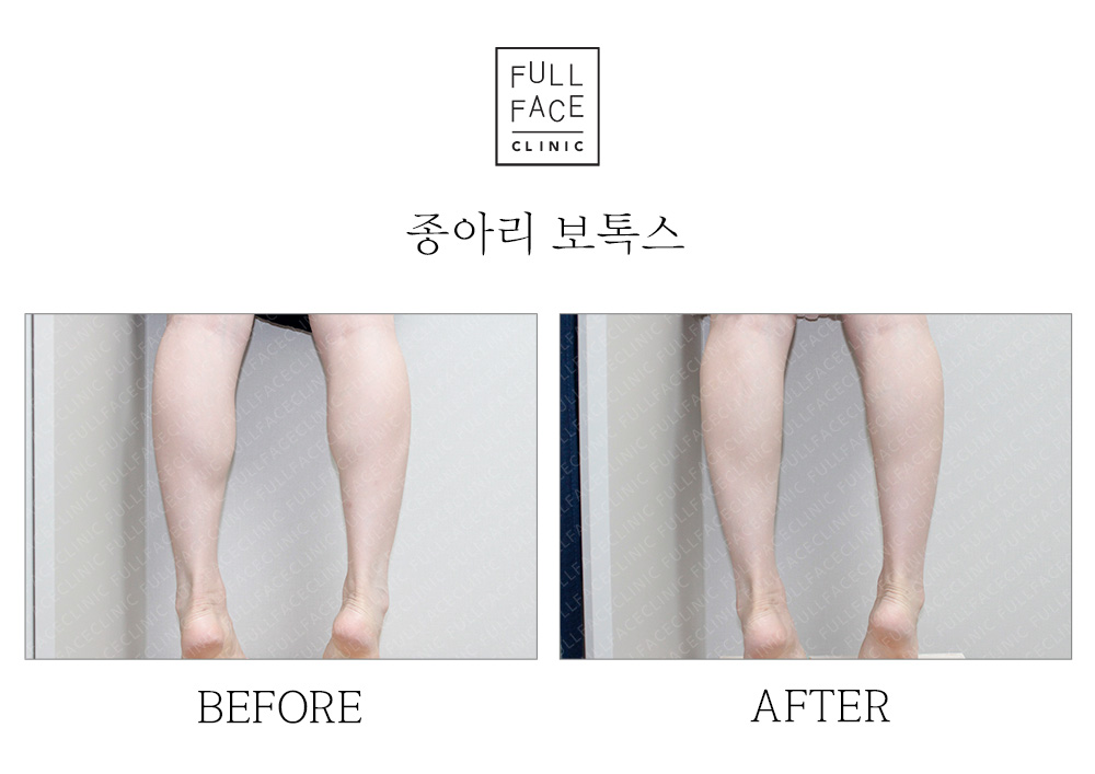 Before & After Case