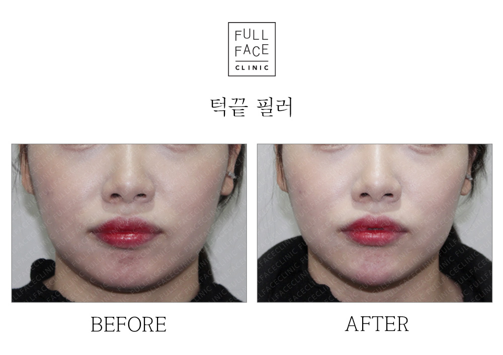 Before & After Case