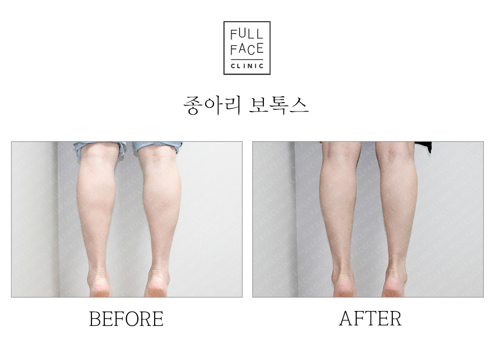 Before & After Case