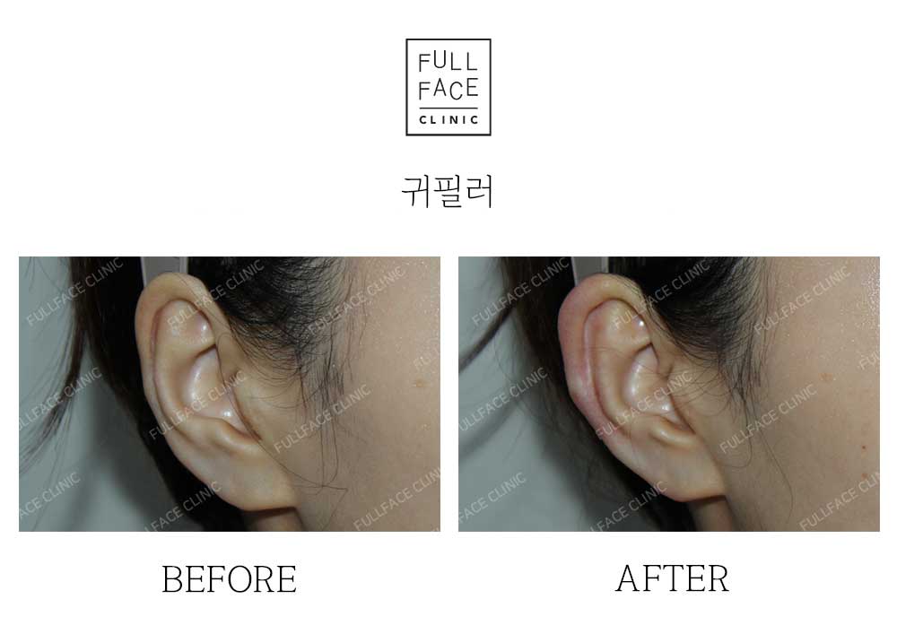 Before & After Case