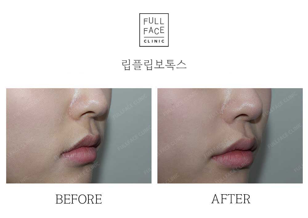 Before & After Case