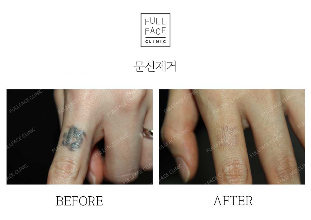 Before & After Case