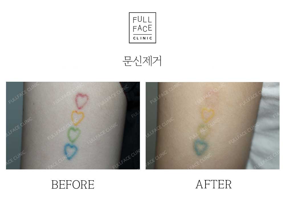 Before & After Case