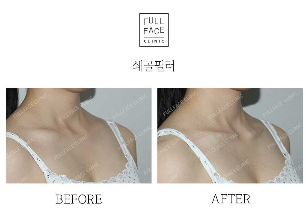 Before & After Case