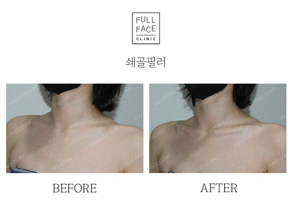 Before & After Case