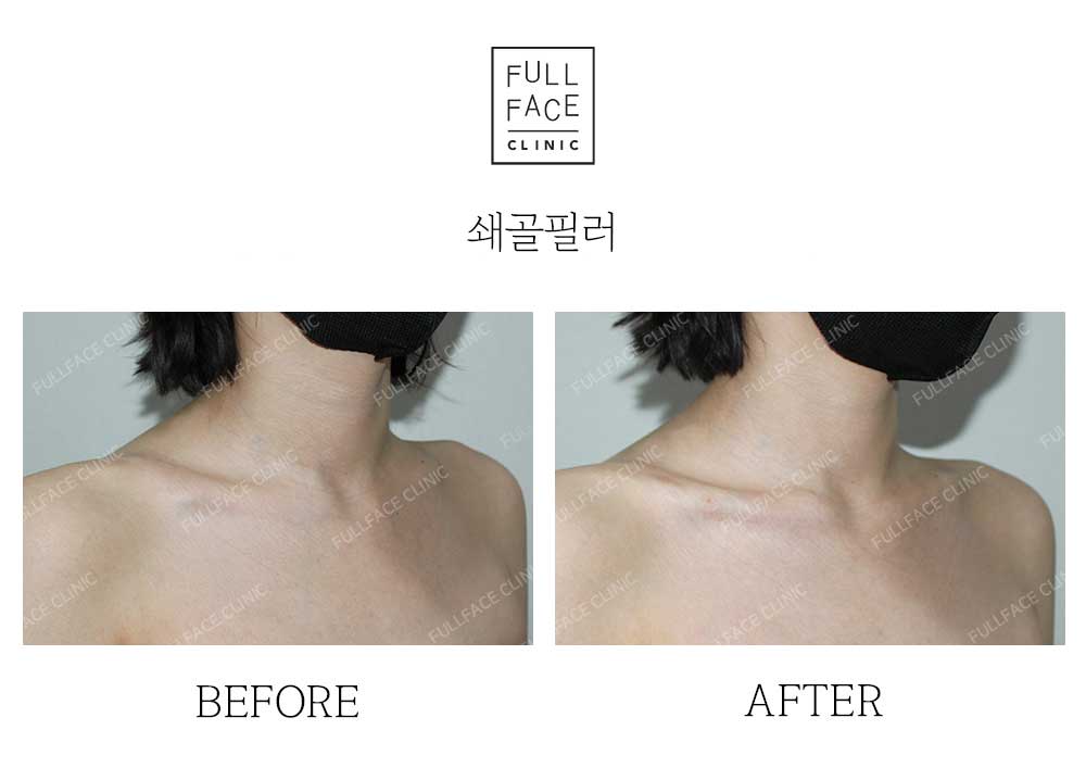 Before & After Case