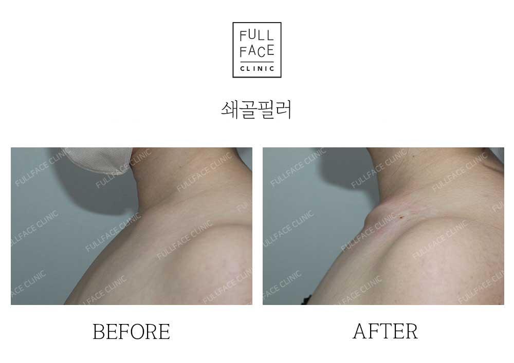Before & After Case
