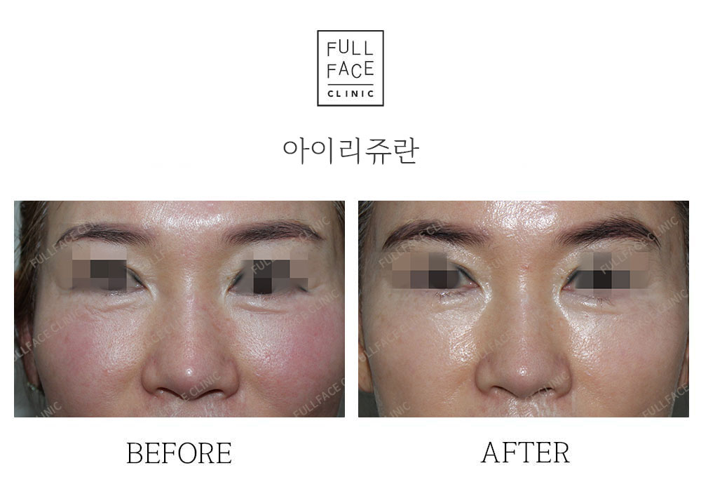 Before & After Case