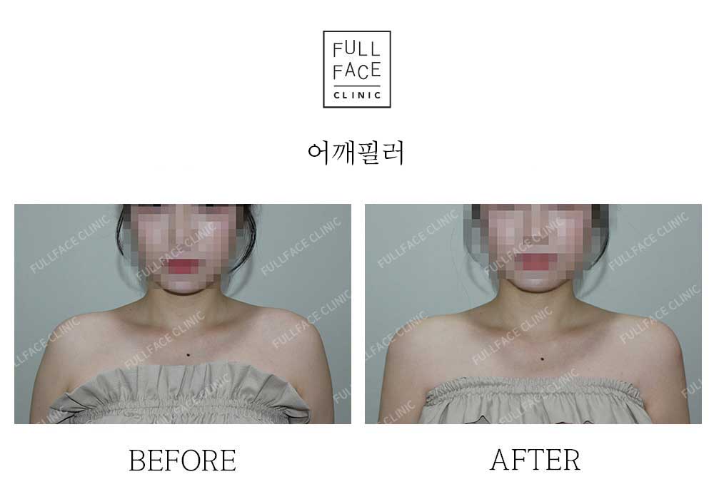 Before & After Case