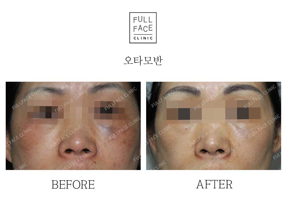 Before & After Case