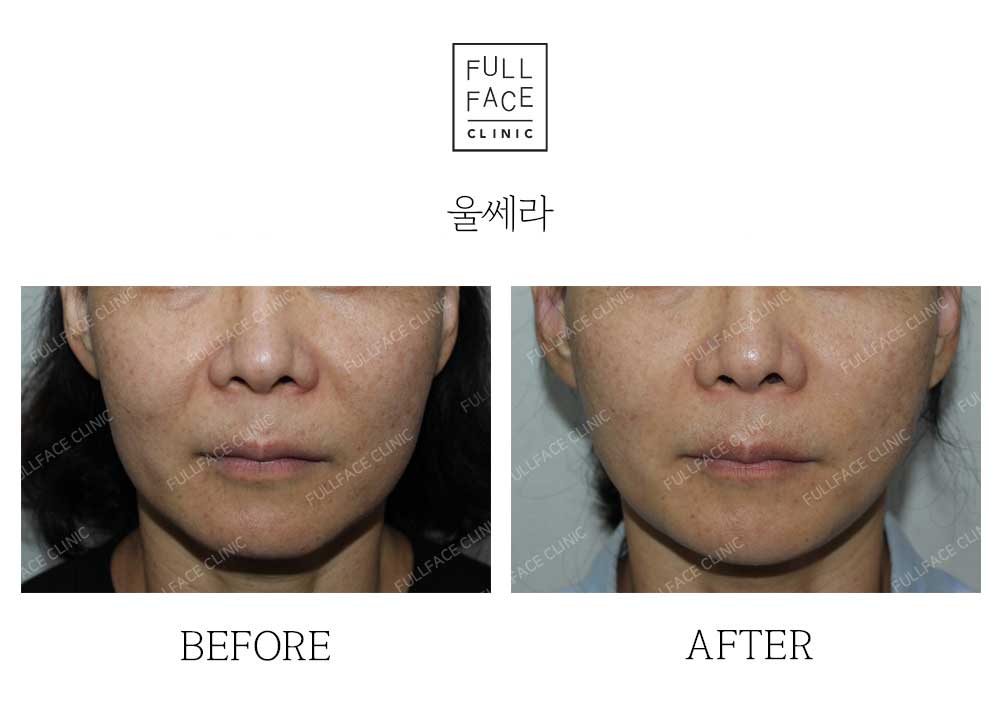 Before & After Case
