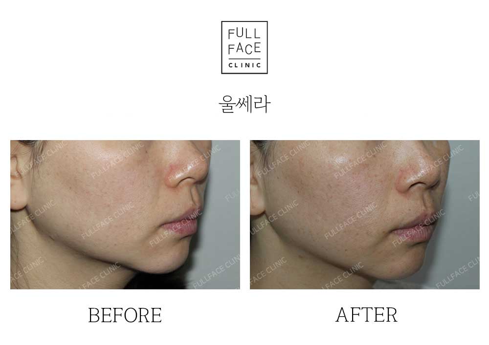 Before & After Case