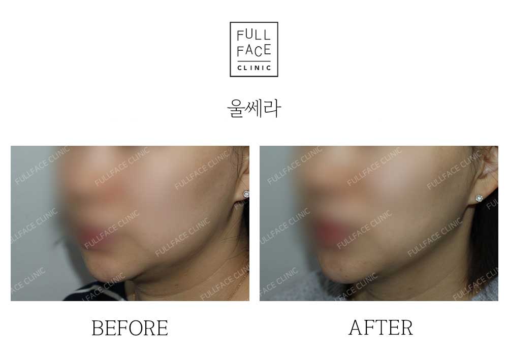 Before & After Case