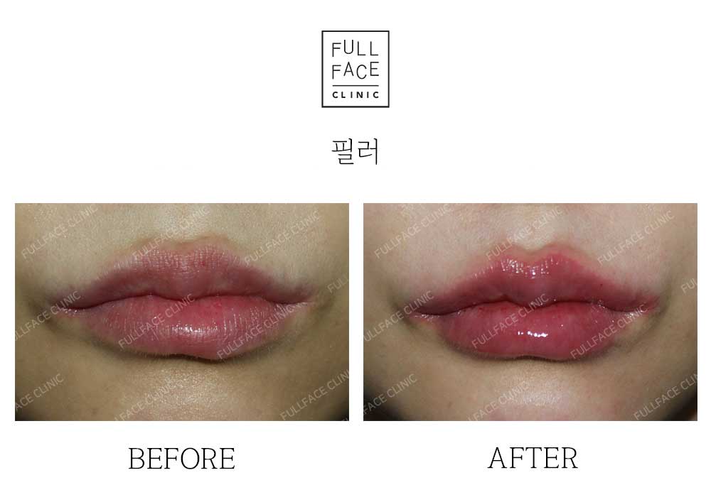 Before & After Case