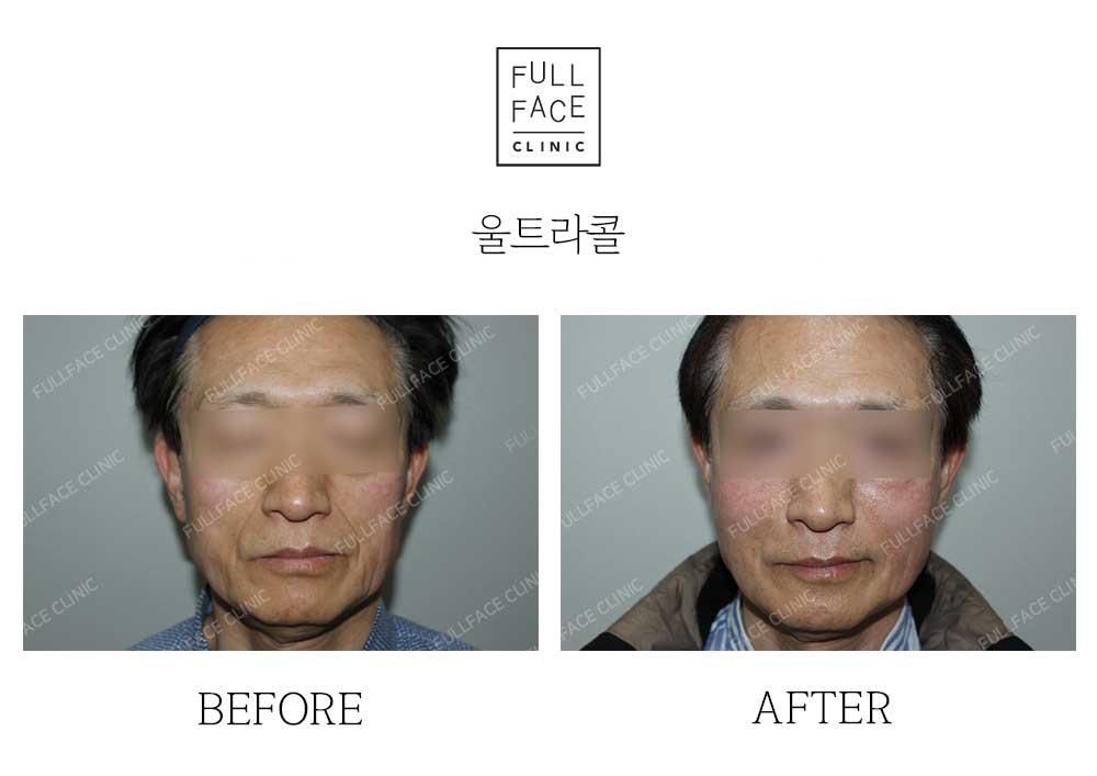 Before & After Case