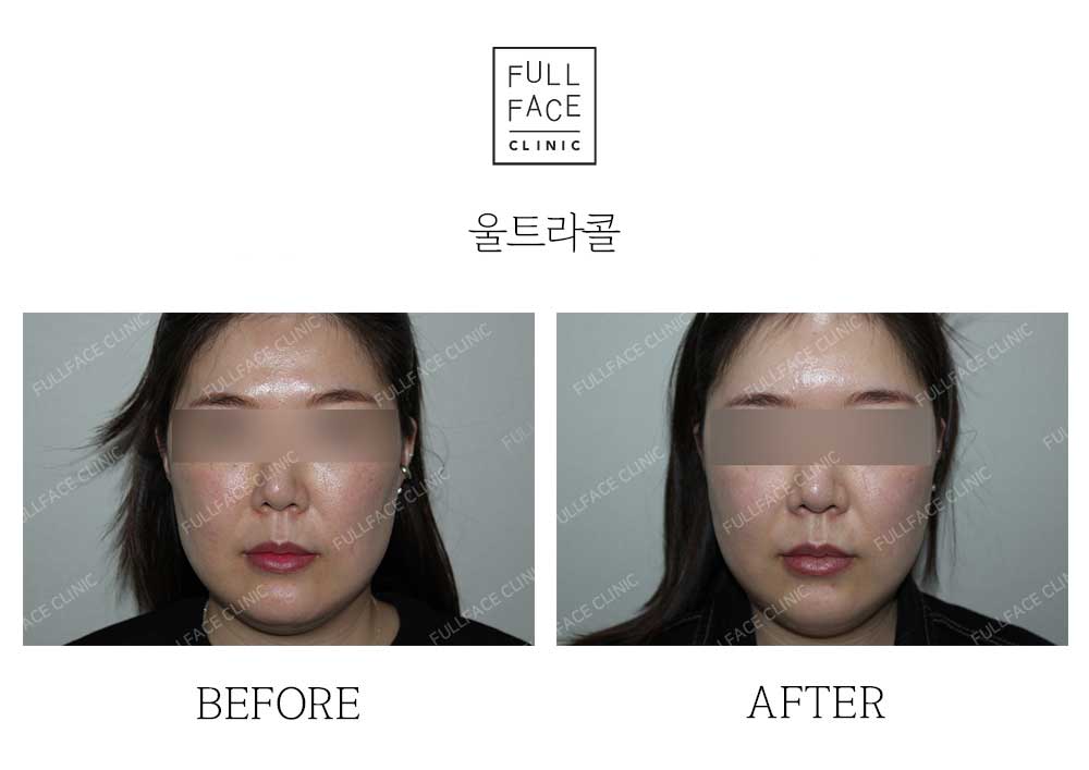 Before & After Case