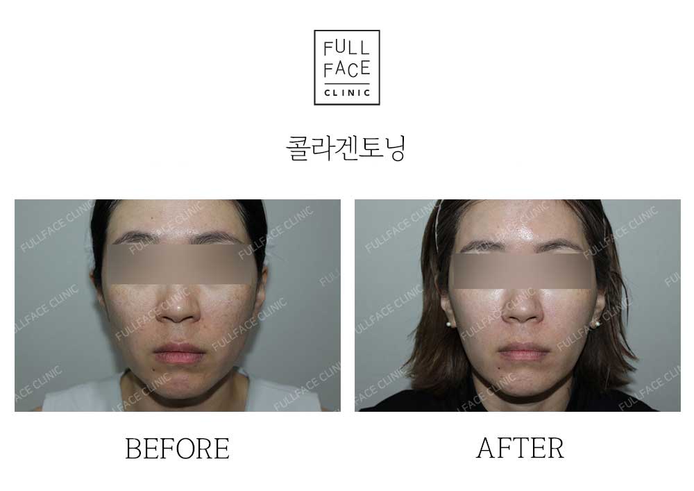 Before & After Case