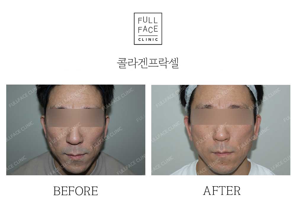 Before & After Case