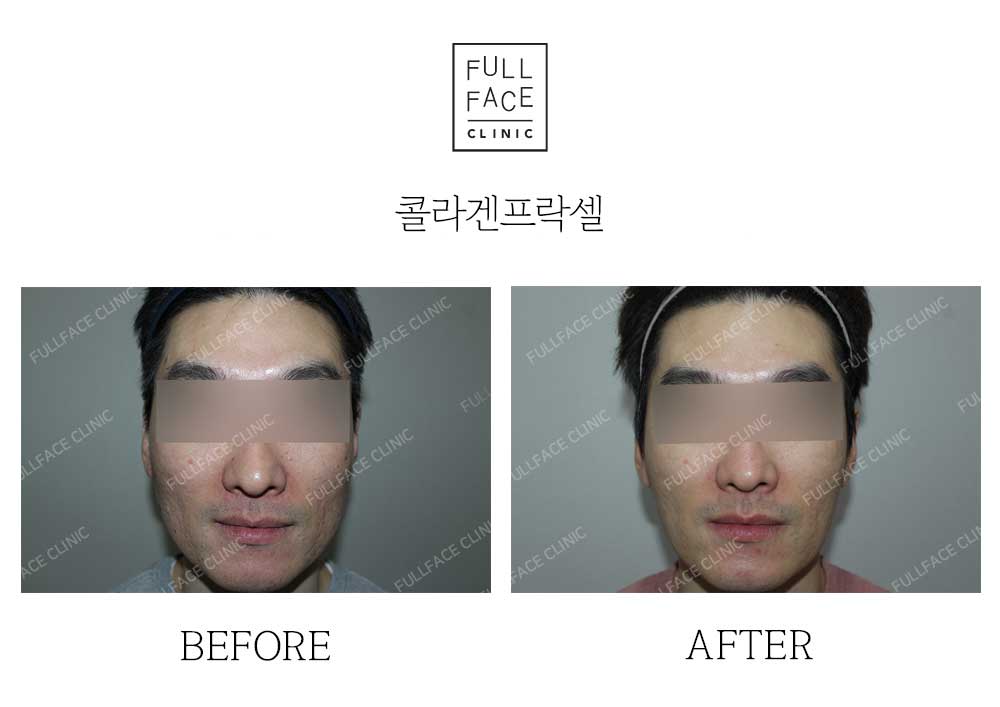 Before & After Case