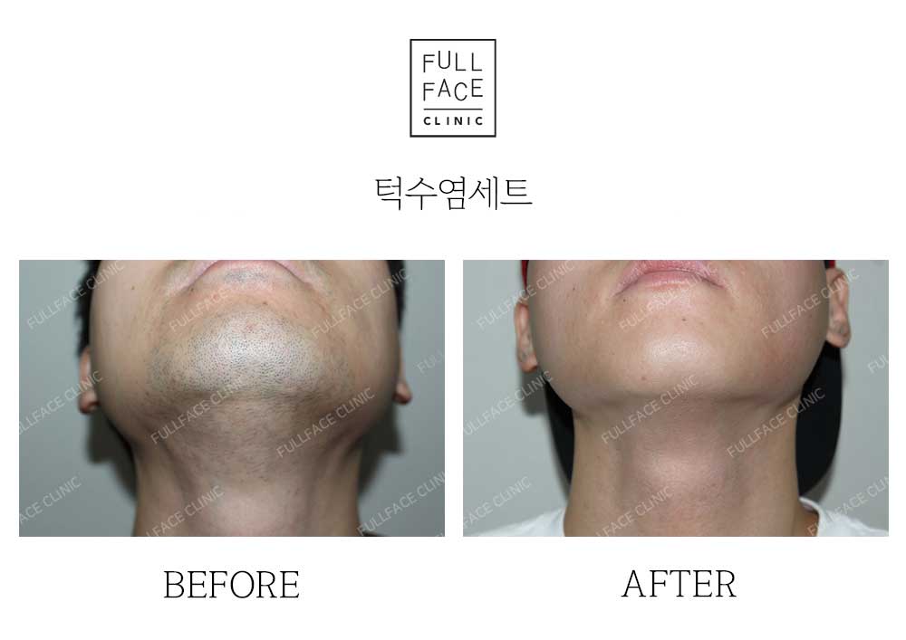 Before & After Case