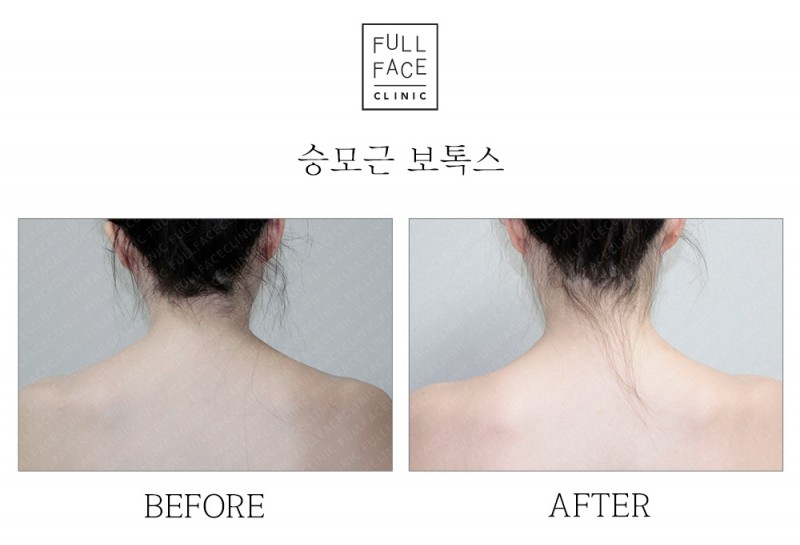 승모근보톡스(19.9.11→19.9.27)
