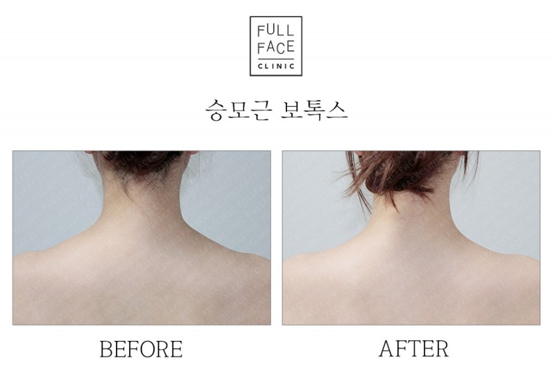 승모근보톡스(19.9.16→19.10.14)