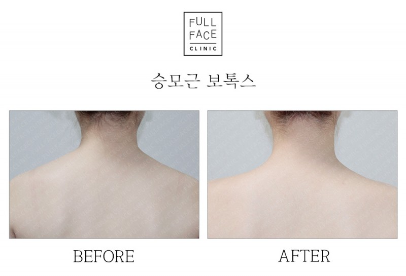 승모근보톡스(19.8.6→19.10.5)