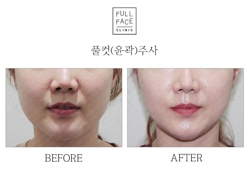 윤곽주사(20.2.1→20.3.1)