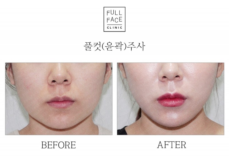 윤곽주사(20.9.3→20.10.8)