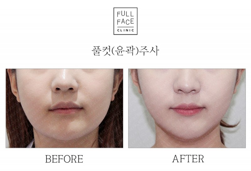 윤곽주사(19.5.28→19.8.21)