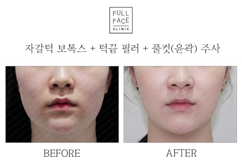 자갈턱+턱끝+윤곽주사(19.6.15→19.7.27)