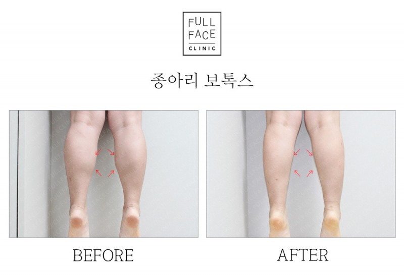 종아리보톡스(19.8.9→19.9.6)