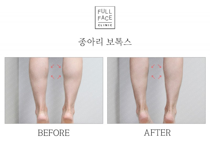 종아리보톡스(19.9.6→19.10.5)