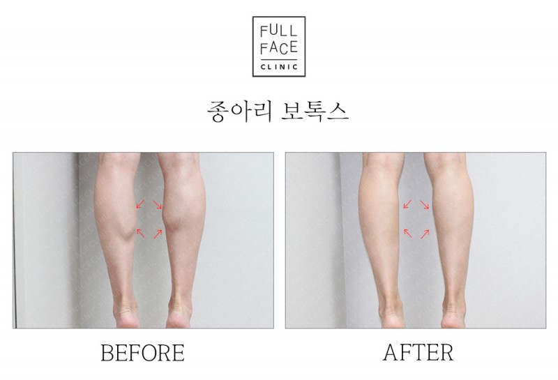 종아리보톡스(19.8.9→19.9.4)